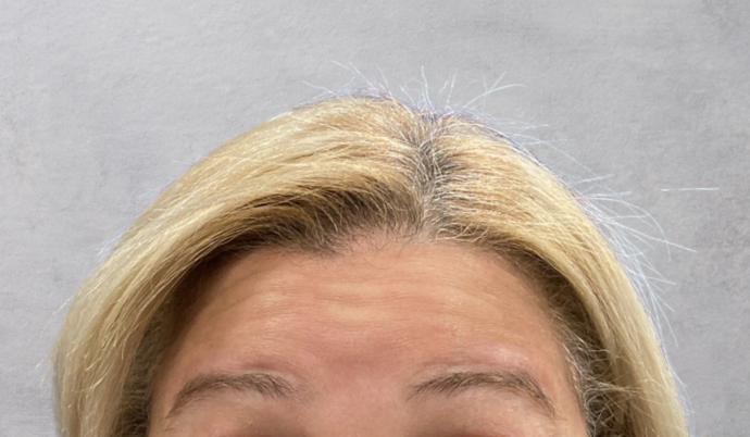 Botox Case 18 - Before