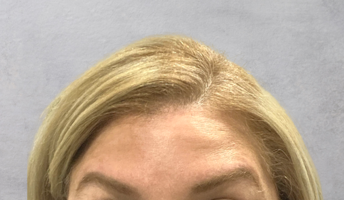 Botox Case 18 - After