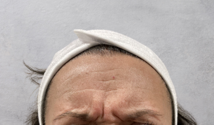 Botox Case 19 - Before