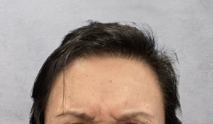 Botox Case 19 - After