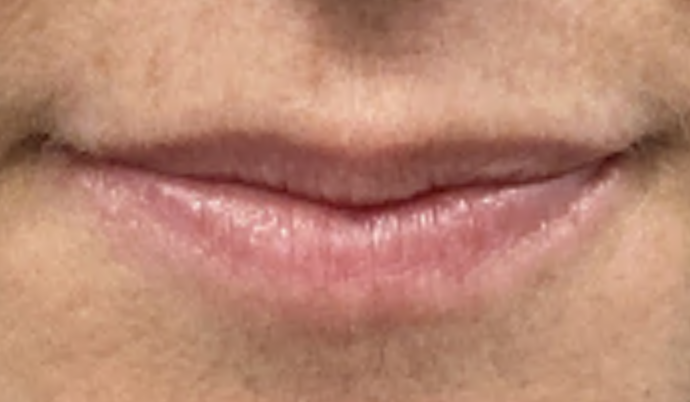 Lip Flip Case 1 - Before