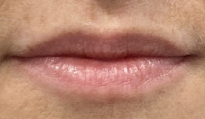 Lip Flip Case 1 - After