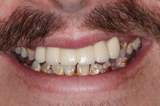 Dental Implants Case 13 - Before