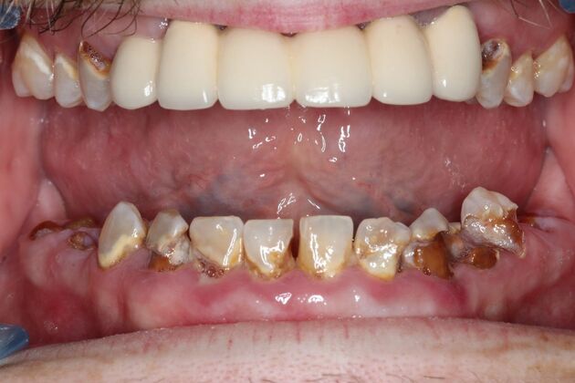 Dental Implants: Case 13 - Before