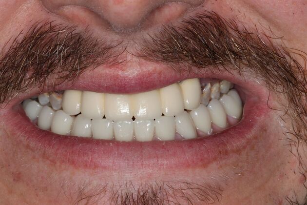 Dental Implants Case 13 - After