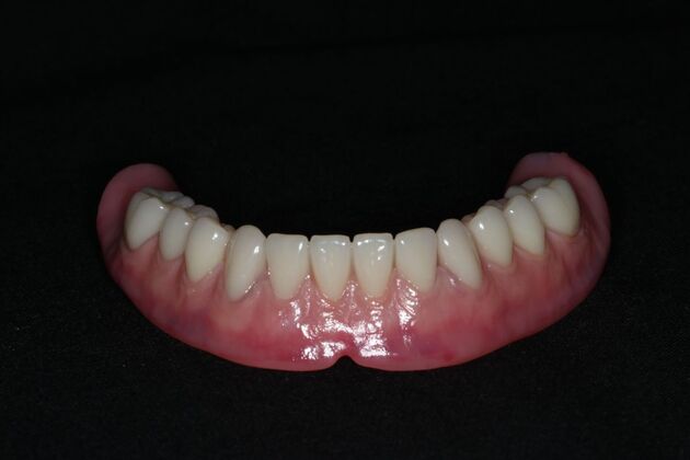 Dental Implants: Case 13 - Lower Locator Denture