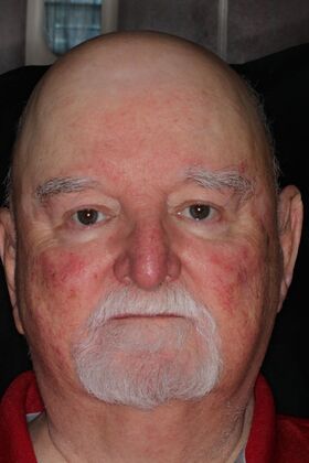 Dentures Case 18 - Before