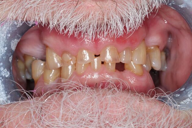 Dentures: Case 18 - Before