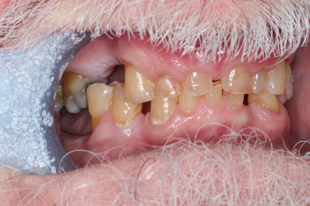 Dentures: Case 18 - Before