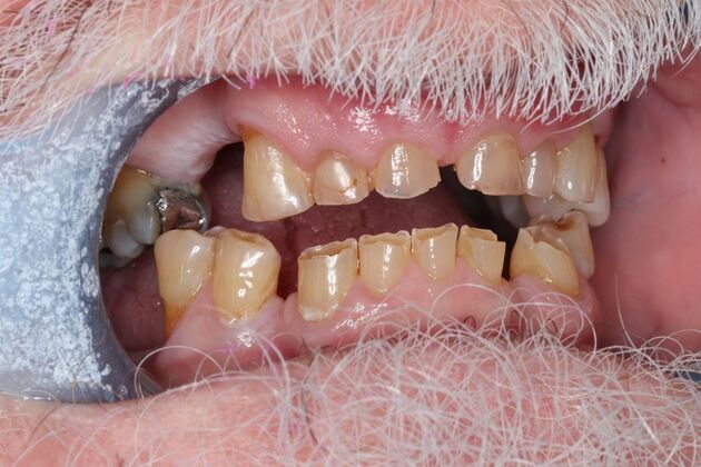 Dentures: Case 18 - Before