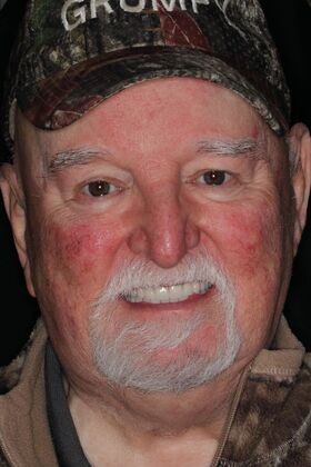 Dentures Case 18 - After