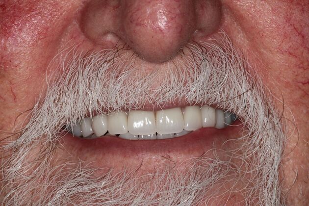 Dentures: Case 18 - After