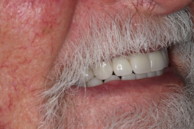 Dentures: Case 18 - After