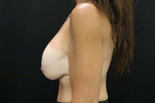 Breast Lift/Breast Lift Augmentation: Case 31 - Before