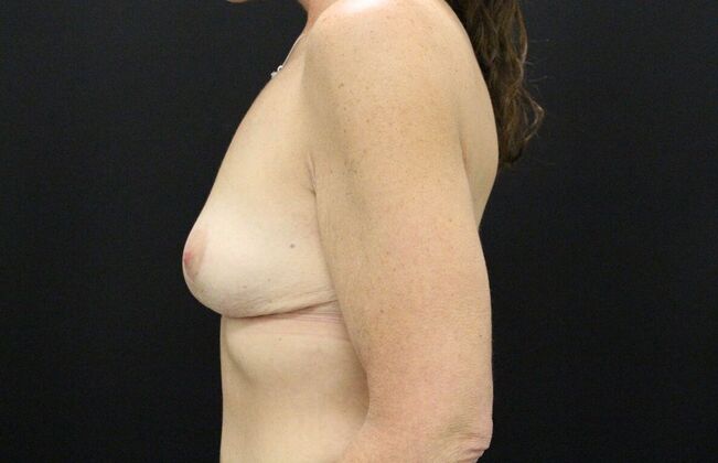 Breast Lift/Breast Lift Augmentation: Case 31 - After