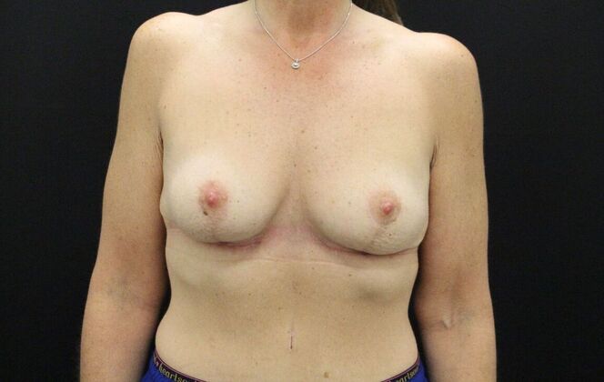 Breast Lift/Breast Lift Augmentation Case 31 - After