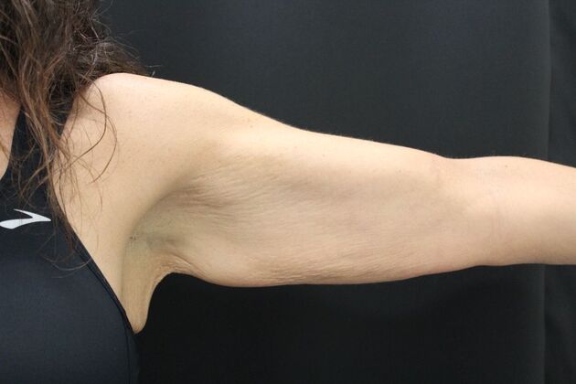 Arm Lift: Case 17 - Before