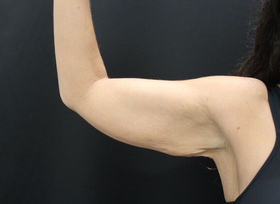 Arm Lift: Case 17 - Before