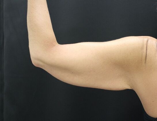 Arm Lift: Case 17 - Before