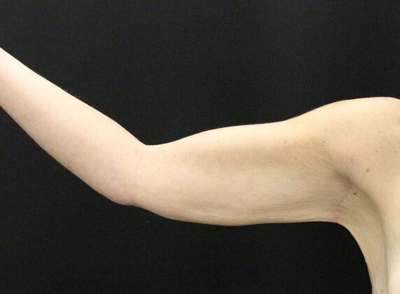 Arm Lift: Case 17 - After