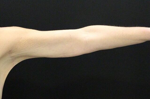 Arm Lift: Case 17 - After