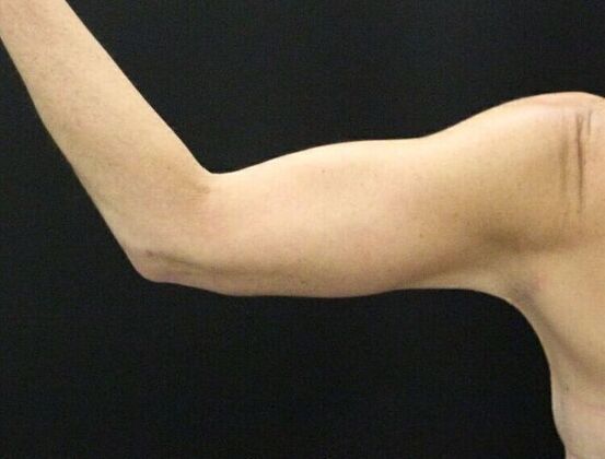 Arm Lift: Case 17 - After