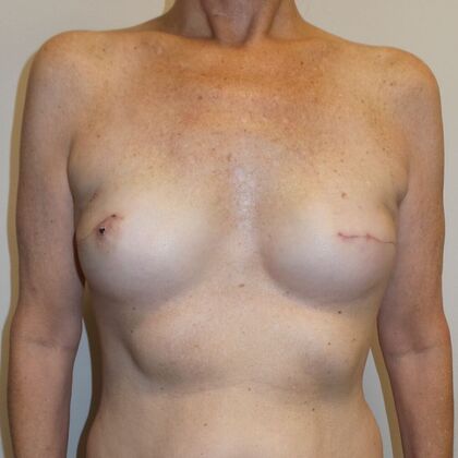 DIEP Flap Breast Reconstruction Case 56 - Before