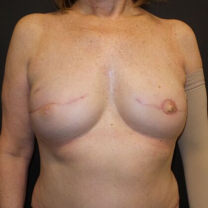 DIEP Flap Breast Reconstruction Case 56 - After