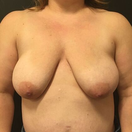DIEP Flap Breast Reconstruction Case 3 - Before
