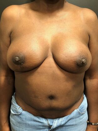 DIEP Flap Breast Reconstruction Case 4 - After