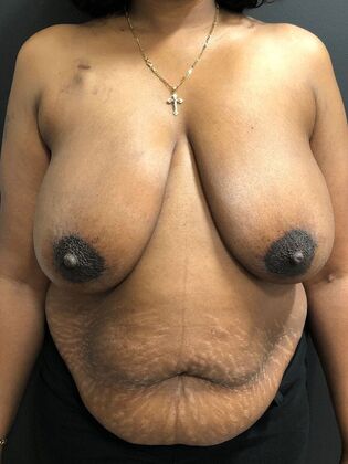 DIEP Flap Breast Reconstruction Case 6 - Before