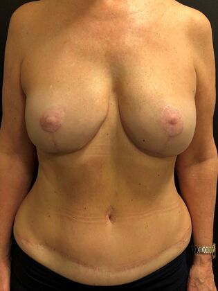 DIEP Flap Breast Reconstruction Case 14 - After