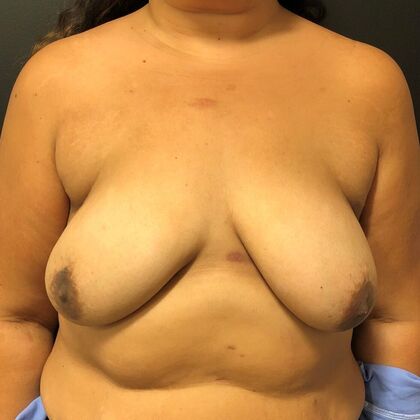 DIEP Flap Breast Reconstruction Case 7 - Before