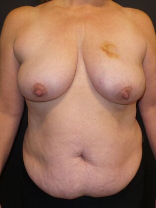 DIEP Flap Breast Reconstruction Case 16 - Before