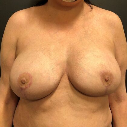 DIEP Flap Breast Reconstruction Case 5 - After
