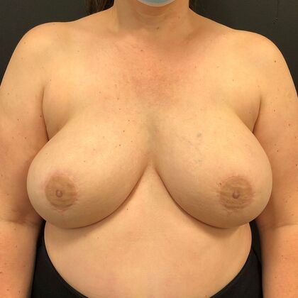 DIEP Flap Breast Reconstruction Case 13 - After