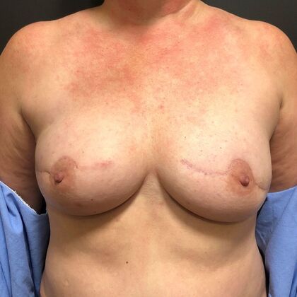 DIEP Flap Breast Reconstruction Case 9 - After