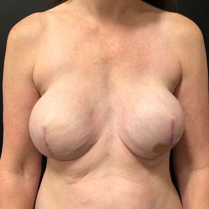 DIEP Flap Breast Reconstruction Case 19 - Before