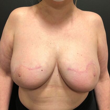 DIEP Flap Breast Reconstruction Case 21 - After