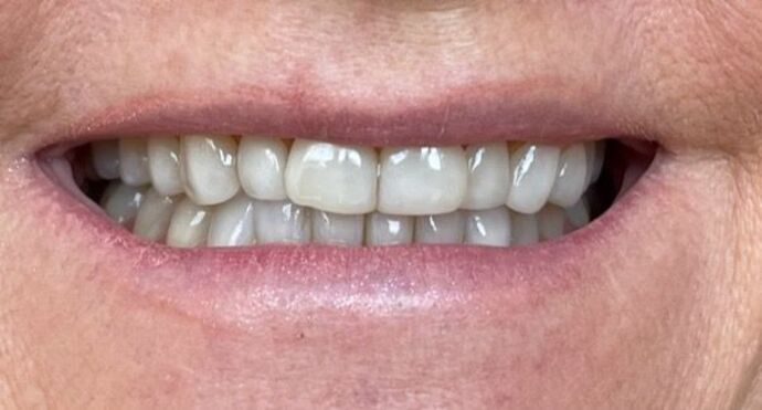 Porcelain Veneers: Case 33 - Before