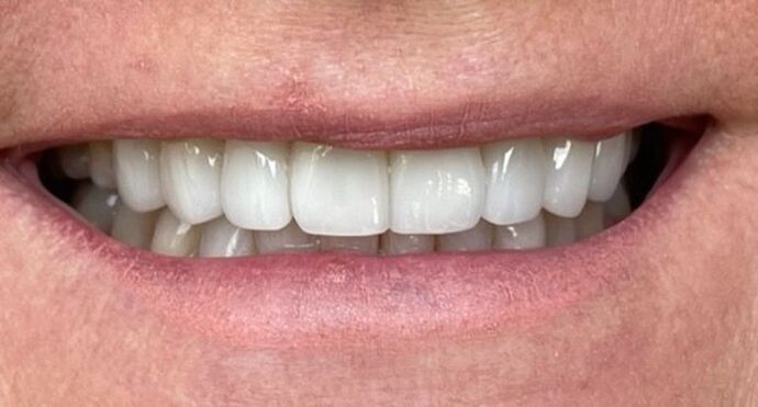 Porcelain Veneers: Case 33 - After