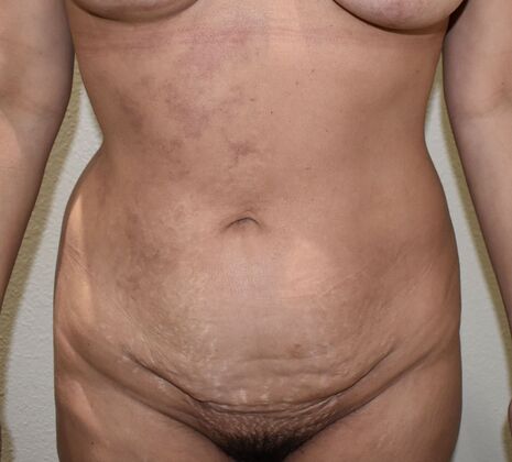 Tummy Tuck (Abdominoplasty): Case 397 - Before