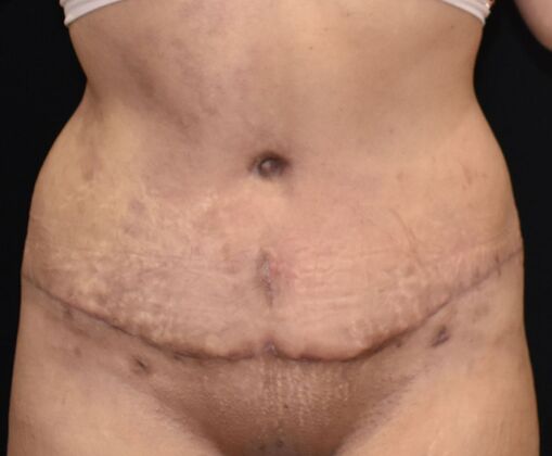 Tummy Tuck (Abdominoplasty): Case 397 - After