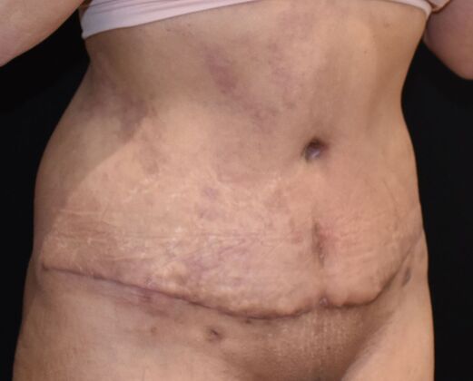 Tummy Tuck (Abdominoplasty): Case 397 - After