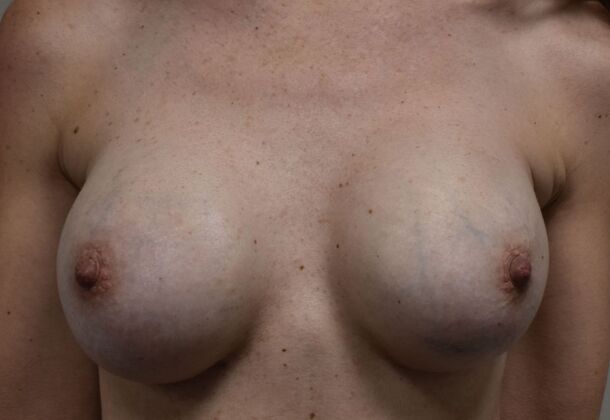 Breast Revision: Case 205 - After