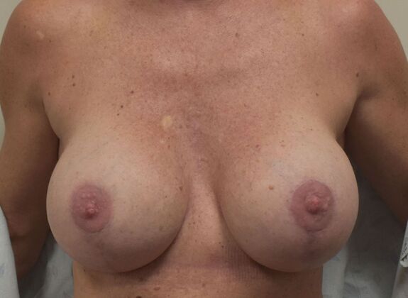Breast Revision: Case 206 - After