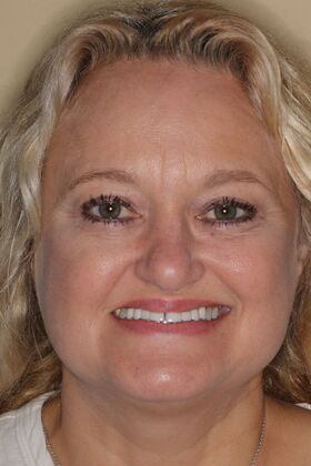 Dental Crowns Case 36 - Before