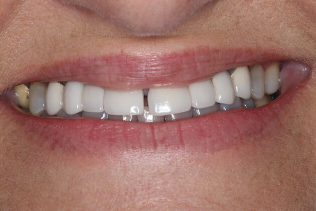 Dental Crowns: Case 36 - Before