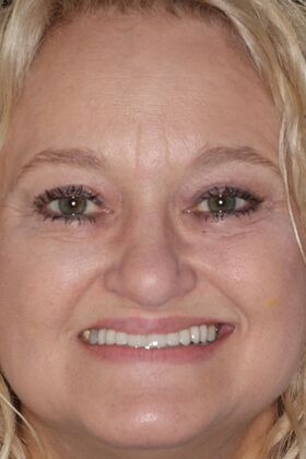 Dental Crowns Case 36 - After