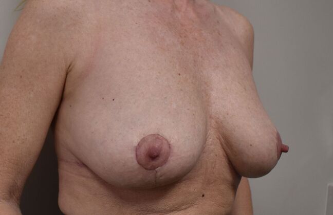 Breast Implant Removal: Case 22 - After
